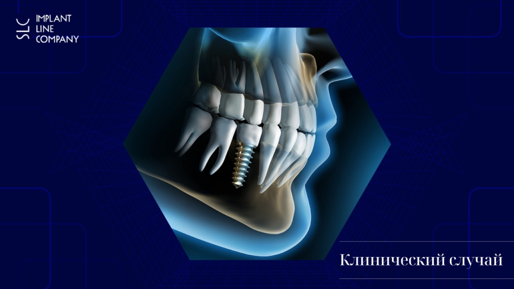 Немедленная имплантация